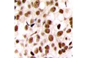 Immunohistochemical analysis of C/EBP zeta staining in human breast cancer formalin fixed paraffin embedded tissue section. (DDIT3 antibody  (N-Term))