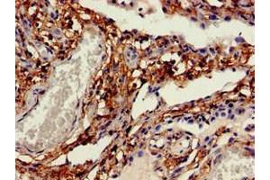 Immunohistochemistry of paraffin-embedded human lung cancer using ABIN7146203 at dilution of 1:100 (OB Cadherin antibody  (AA 637-796))