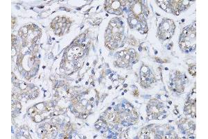 Immunohistochemistry of paraffin-embedded human breast cancer using BRCA1 antibody. (BRCA1 antibody  (AA 120-220))