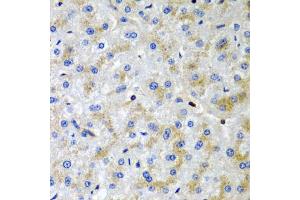 Immunohistochemistry of paraffin-embedded human liver injury using SRGN antibody (ABIN5974179) at dilution of 1/200 (40x lens). (SRGN antibody)