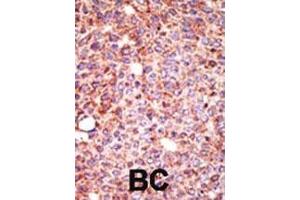 Formalin-fixed and paraffin-embedded human cancer tissue reacted with the primary antibody, which was peroxidase-conjugated to the secondary antibody, followed by AEC staining. (MGAT3 antibody  (N-Term))