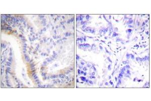 Immunohistochemistry analysis of paraffin-embedded human lung carcinoma tissue, using urocortin antibody. (Urocortin antibody  (C-Term))