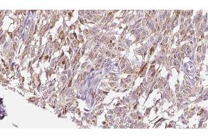 ABIN6276527 at 1/100 staining Human Melanoma tissue by IHC-P. (CRH antibody  (N-Term))