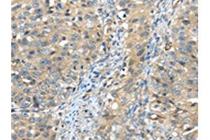 The image on the left is immunohistochemistry of paraffin-embedded Human breast cancer tissue using ABIN7191125(ISM2 Antibody) at dilution 1/45, on the right is treated with synthetic peptide. (Isthmin 2 antibody)