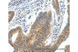 Immunohistochemistry of Human gastric cancer using ECE2 Polyclonal Antibody at dilution of 1:40 (ECE2 antibody)