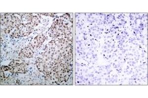 Immunohistochemistry analysis of paraffin-embedded human breast carcinoma, using p53 (Phospho-Ser315) Antibody. (p53 antibody  (pSer315))