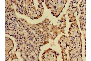 Immunohistochemistry of paraffin-embedded human lung cancer using ABIN7143798 at dilution of 1:100 (A2ML1 antibody  (AA 625-751))