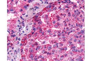 Anti-BAI1 antibody IHC of human Lung, Adenocarcinoma. (BAI1 antibody  (C-Term))