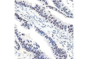 Immunohistochemistry of paraffin-embedded human colon carcinoma using N Rabbit mAb (ABIN7268774) at dilution of 1:100 (40x lens). (NAT10 antibody)