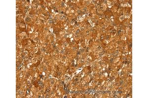 Immunohistochemistry of Human liver cancer using PYGM Polyclonal Antibody at dilution of 1:30