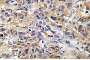 Immunohistochemistry (IHC) analyzes of COX17 antibody in paraffin-embedded human liver carcinoma tissue.