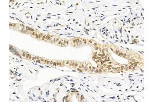 ABIN7094862 and ABIN7098913 at 1/100 staining Human kidney cancer by IHC-P. (HAS2 antibody  (C-Term))