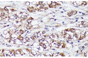 Immunohistochemistry of paraffin-embedded Human liver cancer using MTHFD2 Polyclonal Antibody at dilution of 1:100 (40x lens). (MTHFD2 antibody)