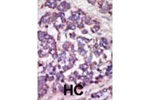 Formalin-fixed and paraffin-embedded human cancer tissue reacted with the primary antibody, which was peroxidase-conjugated to the secondary antibody, followed by AEC staining. (LATS1 antibody  (N-Term))