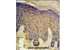 HAUS4 Antibody (C-term) (ABIN651422 and ABIN2840229) IHC analysis in formalin fixed and paraffin embedded skin carcinoma followed by peroxidase conjugation of the secondary antibody and DAB staining. (C14orf94 antibody  (C-Term))