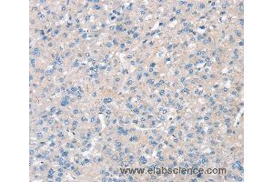 Immunohistochemistry of Human liver cancer using SNX3 Polyclonal Antibody at dilution of 1:30