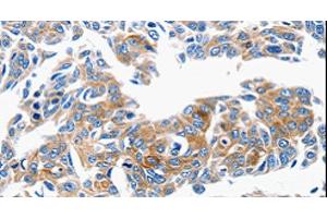 Immunohistochemistry of paraffin-embedded Human lung cancer tissue using CCL6 Polyclonal Antibody at dilution 1:50 (CCL6 antibody)