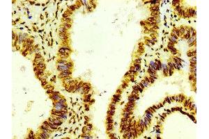IHC image of ABIN7127297 diluted at 1:100 and staining in paraffin-embedded human colon cancer performed on a Leica BondTM system. (Recombinant HIST1H4A antibody)
