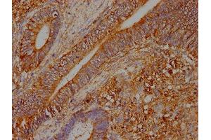 IHC image of ABIN7173618 diluted at 1:400 and staining in paraffin-embedded human colon cancer performed on a Leica BondTM system. (WARS antibody  (AA 27-99))