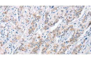 Immunohistochemistry of paraffin-embedded Human gastric cancer tissue using PAPSS1 Polyclonal Antibody at dilution 1:40 (PAPSS1 antibody)