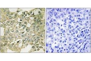 Immunohistochemistry analysis of paraffin-embedded human breast carcinoma, using MYT1 (Phospho-Ser83) Antibody. (MYT1 antibody  (pSer83))