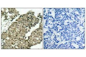 Immunohistochemical analysis of paraffin-embedded human breast carcinoma tissue using G3BP-1(Phospho-Ser232) Antibody(left) or the same antibody preincubated with blocking peptide(right). (G3BP1 antibody  (pSer232))