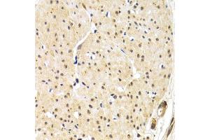 Immunohistochemistry of paraffin-embedded human gastric cancer using TERF1 antibody (ABIN1683138, ABIN3015078, ABIN3015079 and ABIN6213631) at dilution of 1:200 (40x lens).