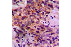 Immunohistochemical analysis of Caspase 2 staining in human breast cancer formalin fixed paraffin embedded tissue section. (Caspase 2 antibody  (Center))