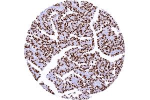 Pulmonary adenocarcinoma with strong TTF1 staining of all tumor cells (Recombinant NKX2-1 antibody)