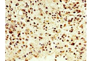 IHC image of ABIN7149450 diluted at 1:500 and staining in paraffin-embedded human glioma cancer performed on a Leica BondTM system. (D Amino Acid Oxidase antibody  (AA 1-347))