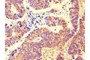 Immunohistochemistry of paraffin-embedded human ovarian cancer using ABIN7169495 at dilution of 1:100 (SH3BP5 antibody  (AA 49-455))