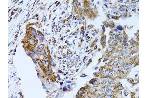Immunohistochemistry of paraffin-embedded human breast cancer using FABP4 antibody.