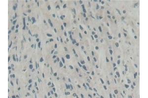 Detection of ABI1 in Human Prostate cancer Tissue using Polyclonal Antibody to Abl Interactor 1 (ABI1) (ABI1 antibody  (AA 1-182))