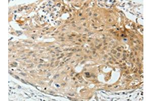 The image on the left is immunohistochemistry of paraffin-embedded Human cervical cancer tissue using ABIN7193012(VEGFA Antibody) at dilution 1/25, on the right is treated with synthetic peptide. (VEGFA antibody)