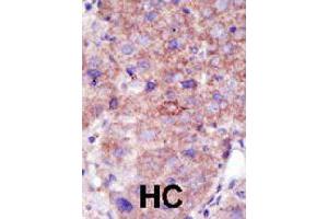 Formalin-fixed and paraffin-embedded human hepatocellular carcinoma tissue reacted with SMURF2 polyclonal antibody  , which was peroxidase-conjugated to the secondary antibody, followed by DAB staining. (SMURF2 antibody  (AA 702-731))