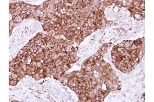IHC-P Image Immunohistochemical analysis of paraffin-embedded human breast cancer, using FIG4, antibody at 1:500 dilution.
