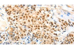 Immunohistochemistry of paraffin-embedded Human esophagus cancer using APPL1 Polyclonal Antibody at dilution of 1:70 (APPL1 antibody)