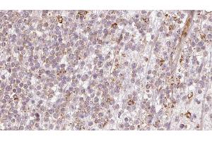 ABIN6273204 at 1/100 staining Human lymph cancer tissue by IHC-P. (CALCOCO2 antibody  (Internal Region))