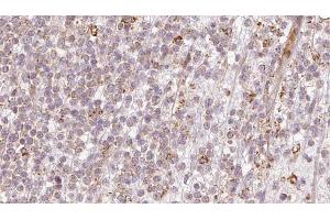 ABIN6273204 at 1/100 staining Human lymph cancer tissue by IHC-P.