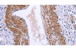Immunohistochemistry of paraffin-embedded Human cervical cancer tissue using GNPAT Polyclonal Antibody at dilution 1:40 (GNPAT antibody)