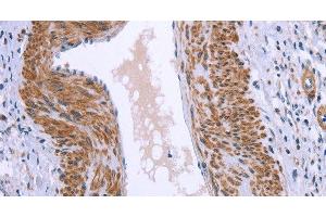 Immunohistochemistry of paraffin-embedded Human cervical cancer tissue using GNPAT Polyclonal Antibody at dilution 1:40