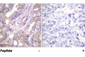 Immunohistochemical analysis of paraffin-embedded human breast carcinoma tissue using ARAF polyclonal antibody . (ARAF antibody)