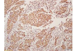 Formalin-fixed and paraffin embedded human lung carcinoma labeled with Anti-CHRM4/mAChR M4 Polyclonal Antibody, Unconjugated (ABIN1387838) at 1:200, followed by conjugation to the secondary antibody and DAB staining (CHRM4 antibody  (AA 1-31))