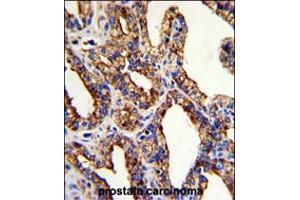 Formalin-fixed and paraffin-embedded human prostate carcinoma with TROP2 Antibody , which was peroxidase-conjugated to the secondary antibody, followed by DAB staining. (TACSTD2 antibody  (AA 162-190))