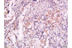 Formalin-fixed and paraffin embedded human lung carcinoma labeled with Anti- Pan FOXD Polyclonal Antibody, Unconjugated  at 1:200 followed by conjugation to the secondary antibody and DAB staining.