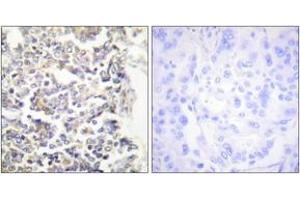 Immunohistochemistry analysis of paraffin-embedded human lung carcinoma tissue, using MARK3 Antibody. (MARK3 antibody  (AA 1-50))