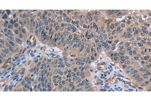 Immunohistochemistry of paraffin-embedded Human lung cancer using p53RFP Polyclonal Antibody at dilution of 1:50 (RNF144B antibody)