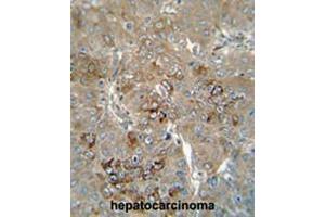 CES4 antibody (N-term) immunohistochemistry analysis in formalin fixed and paraffin embedded human hepatocarcinoma followed by peroxidase conjugation of the secondary antibody and DAB staining. (CES1P1 antibody  (N-Term))