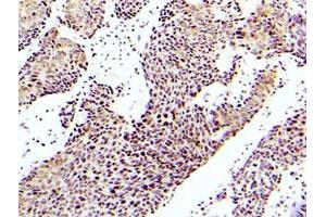 Immunohistochemistry analysis of paraffin-embedded human lung adenocarcinoma tissue with MAP3K5 (phospho S83) polyclonal antibody . (ASK1 antibody  (pSer83))