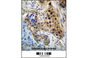 RPL3 Antibody immunohistochemistry analysis in formalin fixed and paraffin embedded human breast carcinoma followed by peroxidase conjugation of the secondary antibody and DAB staining. (RPL3 antibody  (AA 224-251))